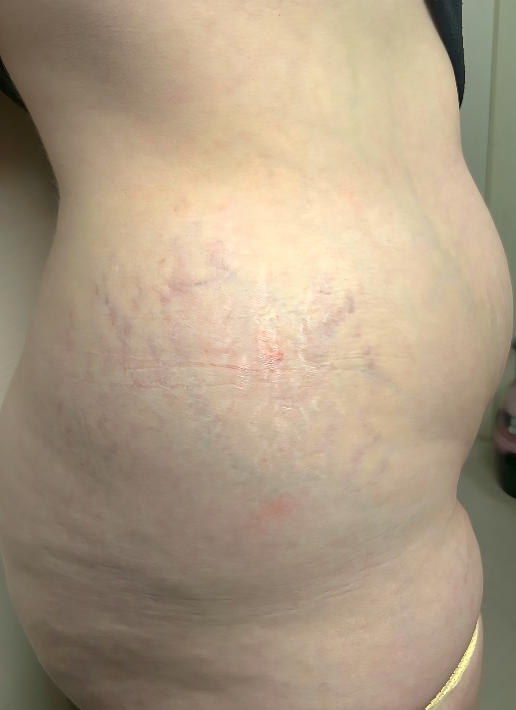 ReCoverDerm Hyperpigmentation Lightening