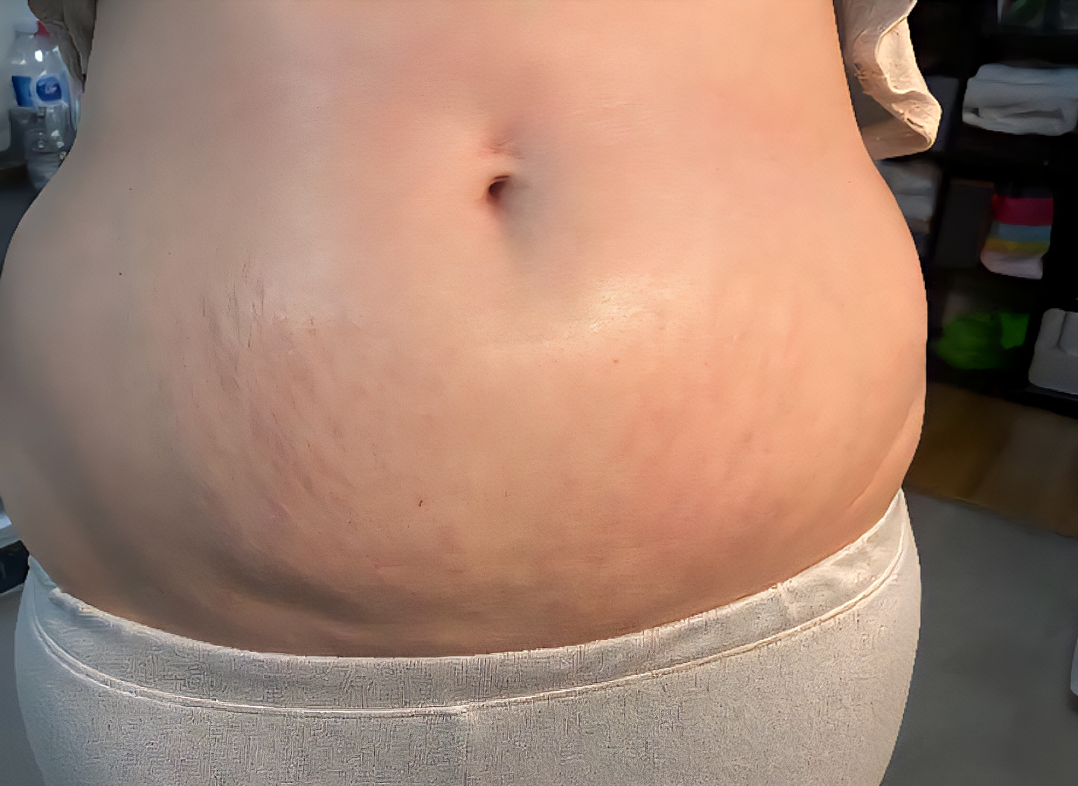 ReCoverDerm Stretch Mark Revision