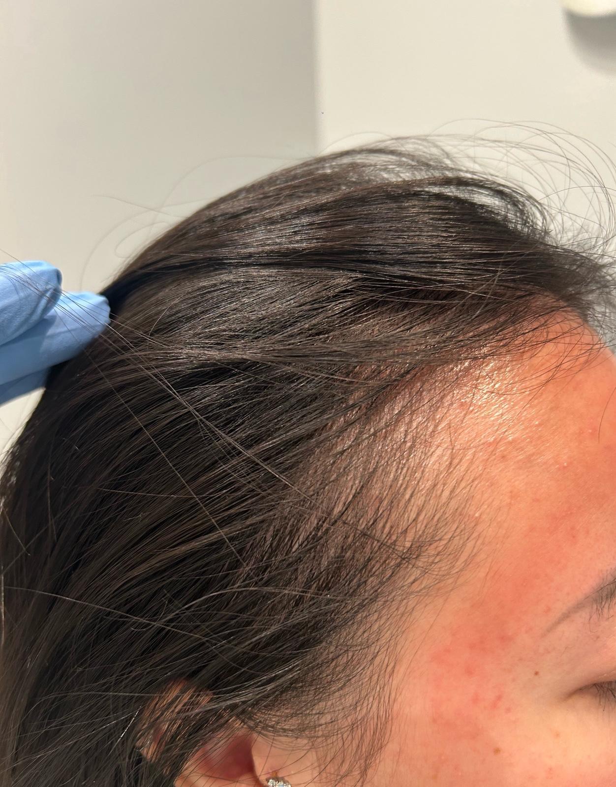 ReCoverDerm Hair Restoration