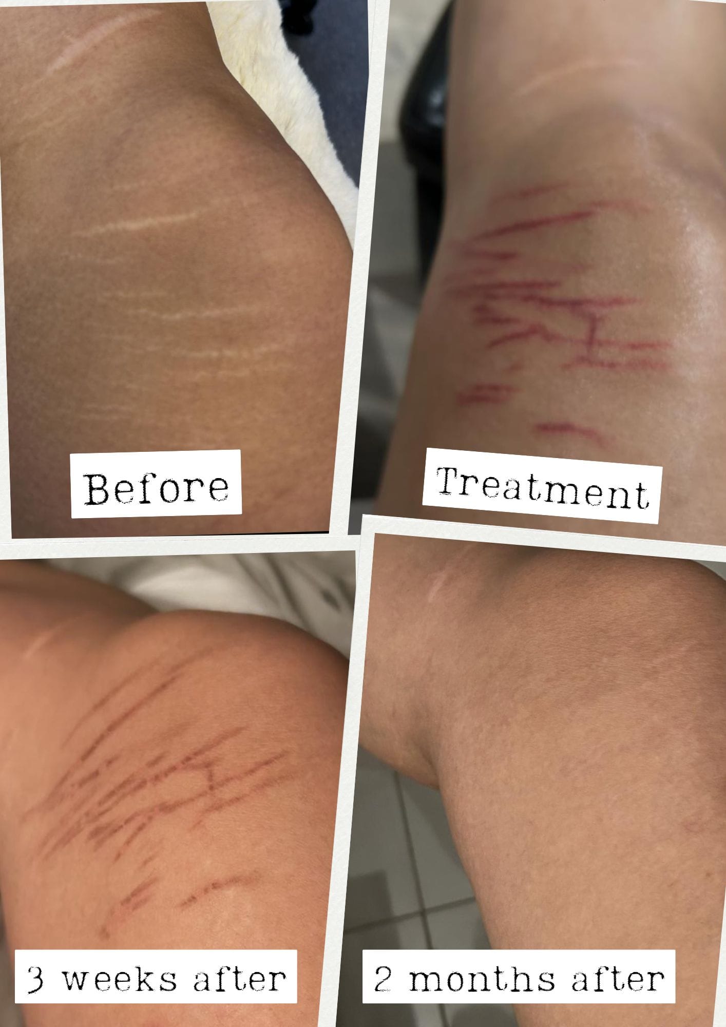 ReCoverDerm Stretch Mark Revision